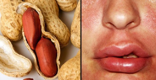 Dị ứng đậu phộng là gì? Cách kiểm soát rủi ro trong chuỗi sản xuất